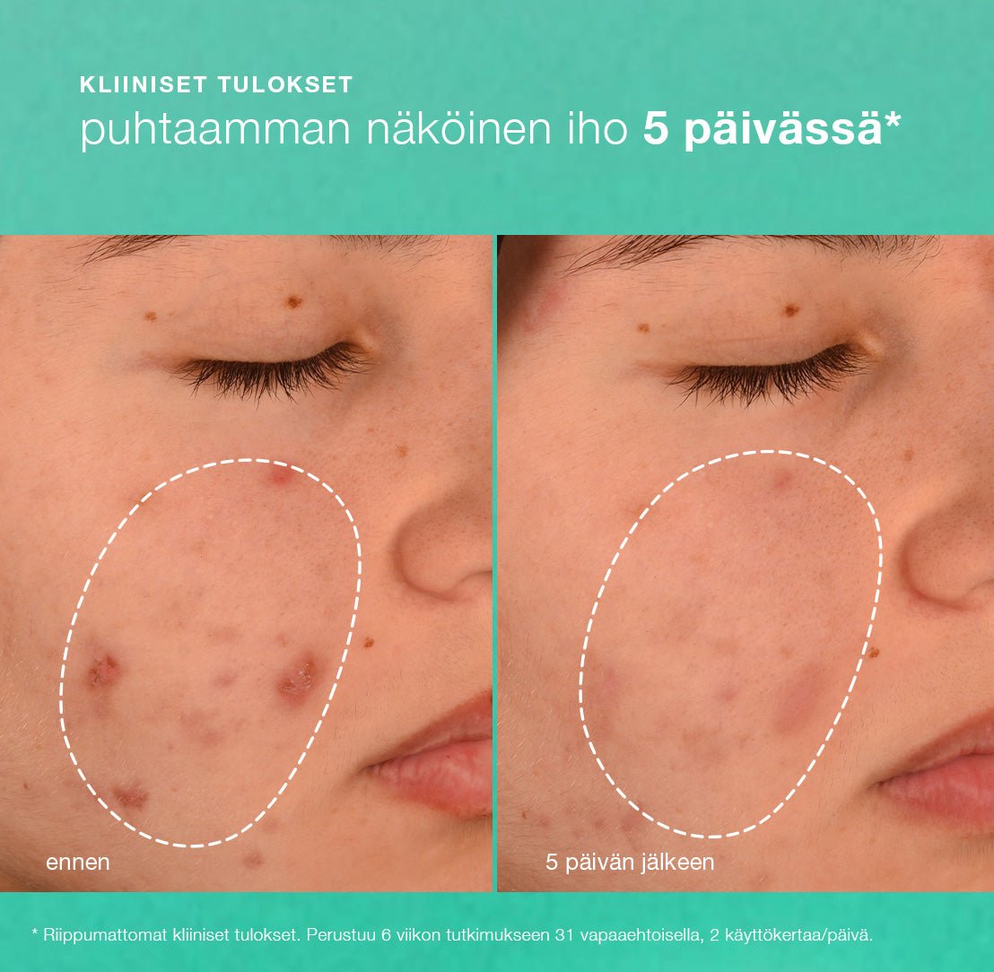 Breakout Biotic Moisturizer - kosteusvoide - Dermalogica Suomi