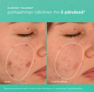 Breakout Biotic Moisturizer - kosteusvoide - Dermalogica Suomi